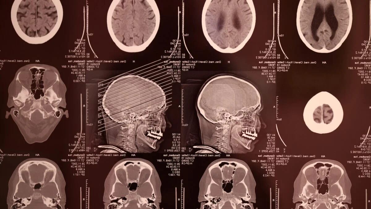 Meta's Brain2Qwerty v2: AI Translates Brain Scans into Text
